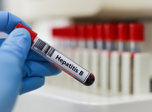 Blood sample tube for hepatitis B virus test analysis.