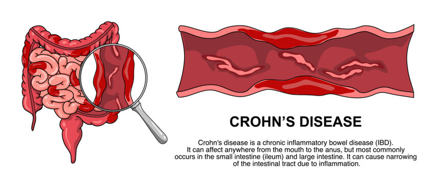 Illustration of Crohn's disease. inflammatory bowel disease, Inflammation of the human digestive system. Vector illustration for medical, science, and educational posters.