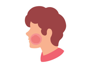 Erythema Infectiosum in Skin Illustration
