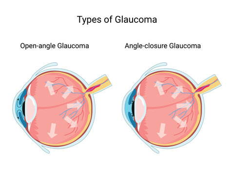 Types of Glaucoma eye. Human Eye anatomy. Eye structure, eye pressure. Treatment. Diagram for education and medical use.  Vector illustration

