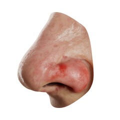 Side view of human nose with inflamed red area skin with Transparent Background
