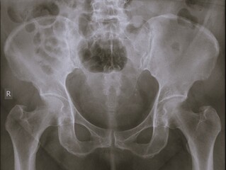 Normal human  pelvis x ray, 