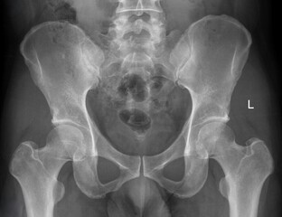 Normal human  pelvis x ray, 