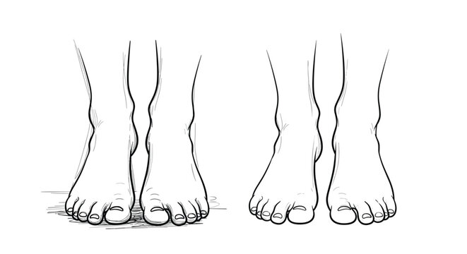 A medical line art illustration comparing the anatomy of a normal foot arch with a flat foot, isolated on white background.