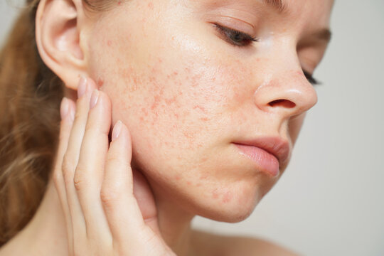 Close-up. Allergic reaction. Woman examines skin irritation on her face, gently touching her cheek with her fingers, looking concerned.	