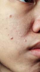 Obraz premium An extreme close-up of a person’s cheek and mouth area, showing natural skin texture with visible pores and small acne blemishes.