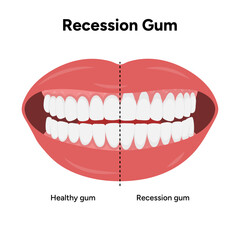 Hand-drawn dental illustration comparing gum recession and healthy gums. Educational infographic the difference between receding gums and normal gum anatomy