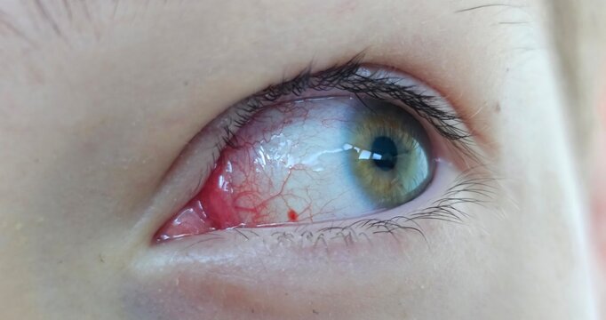 Closeup of green eye with bloodshot conjunctiva