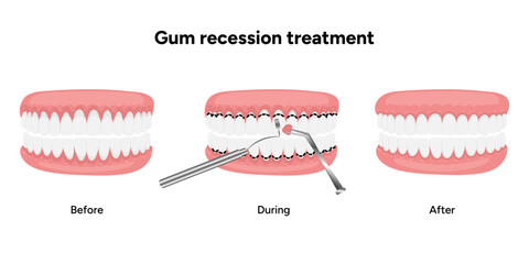 Hand-drawn dental illustration of gum recession treatment. Educational infographic healthy gums and treatment steps for receding gums