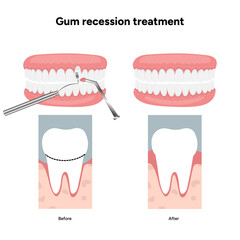 Hand-drawn dental illustration of gum recession treatment with detailed anatomy of teeth and gums
