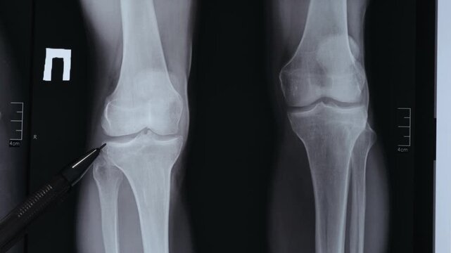 Doctor showing X-ray of disproportions person legs, showing one limb 4 cm shorter than the other.