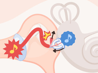 アブミ骨筋反射のイラスト素材