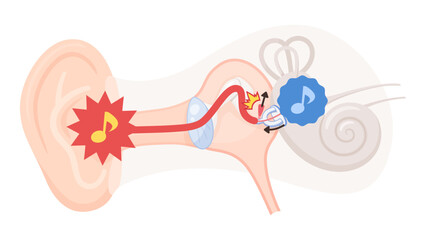 アブミ骨筋反射のイラスト素材