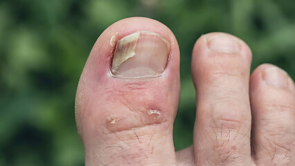 Close up of a damaged human toe with a partially detached toenail and surrounding inflammation, showing skin irritation
