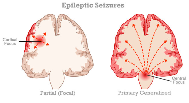 Epileptic seizures epilepsy generalized in human brain. Cross section anatomy. Focal seizures and generalized seizures types. Top view. vector illustration