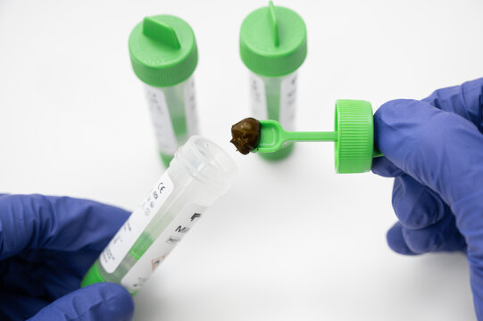 Collecting stool sample for parasite analysis in laboratory
