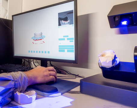 3D scanning of dental gypsum model using CAD CAM scanner in lab, part of digital dentistry workflow for designing metal-ceramic crowns and dental restorations.