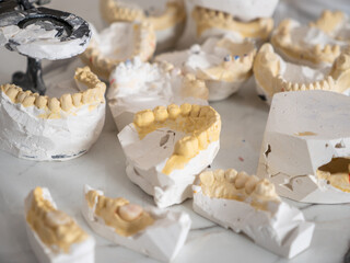 Collection of dental gypsum models with metal-ceramic crowns in lab, used for prosthetic planning, crown fitting, and fabrication in dental restoration work.