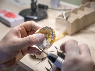 Detailed backside view of metal-ceramic dental crowns being processed on model in lab, showing prosthodontic work and preparation before ceramic layering.