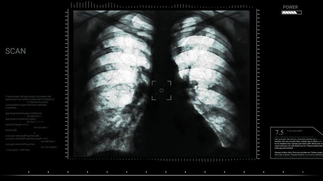 X-Ray Image of Human Lungs Showing Chest Anatomy for Medical Diagnosis