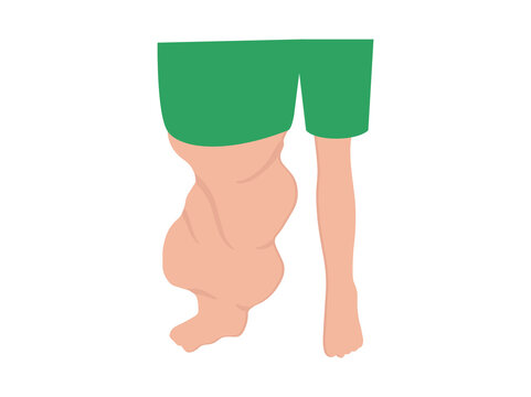 Elephantiasis Disease from Filaria Worm Parasite
