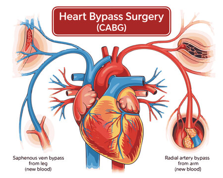 Anatomical Illustration of Heart Bypass Surgery ( CABG) with Vein and Artery Grafts CABG coronary artery bypass grafting