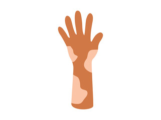 Obraz premium Vitiligo Pigment Loss Clip Art 
