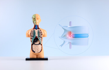 Anatomical model of a human body with two lumbar vertebrae and a disc. Concept of herniated disc, spinal diagnosis, nerve compression assessment.