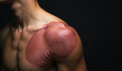Fototapeta premium Close up of man shoulder with large red scar from surgery. Post operation skin healing visible. Medical procedure aftermath shown on dark background. Body injury repair concept.