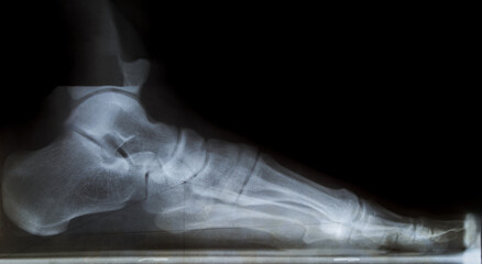 X-ray image of human foot showing flatfoot deformity with collapsed arch in medical diagnostic side view