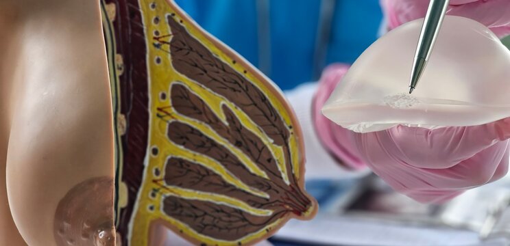 Breast implant rupture causes, diagnosis and treatment. Silicone implant rupture after breast augmentation and oncology