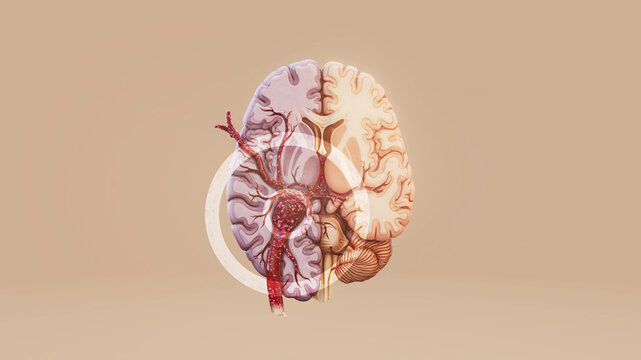 Conceptual 3D illustration of a brain with a blood clot causing a stroke