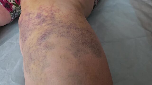 Injury on leg shows bruises and swelling from a recent fall on a hard surface