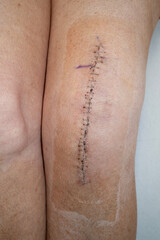 Naklejka premium Woman's knee after knee replacement operation, no dressing, showing surgical staples.