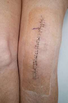 Woman's knee after knee replacement operation, no dressing, showing surgical staples.