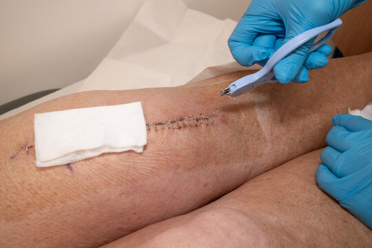 Close up of surgical staples being removed by nurse from woman's knee after knee replacement operation.