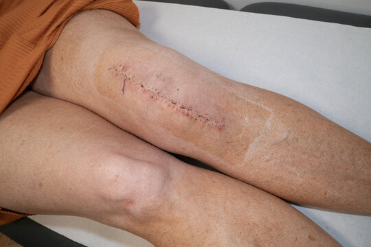 Woman's knee after knee replacement operation, surgical staples removed.