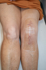 Naklejka premium Woman's knee with sterilised dressing strips after knee replacement operation.