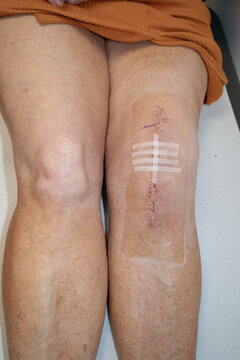 Woman's knee with sterilised dressing strips after knee replacement operation.