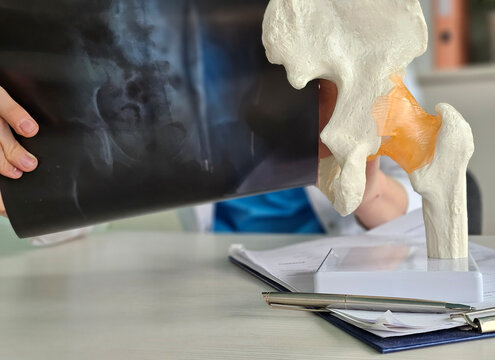 Doctor examines x-ray next to hip model in medical office