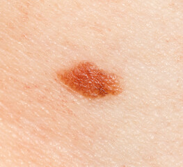 Fototapeta premium A small brown spot on a person's arm