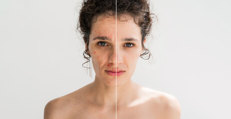 Portrait of a young girl with pimples and acne on face on white background. Female with problematic skin. Collage of problem skin before and after treatment and care. Clean healthy and bad skin