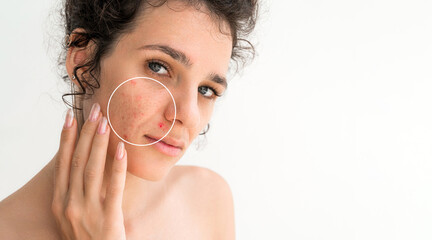 Portrait of a young girl with pimples and red acne on face close up on a white background. Woman with problematic skin. Collage of bad problem skin before and clean healthy after treatment and care
