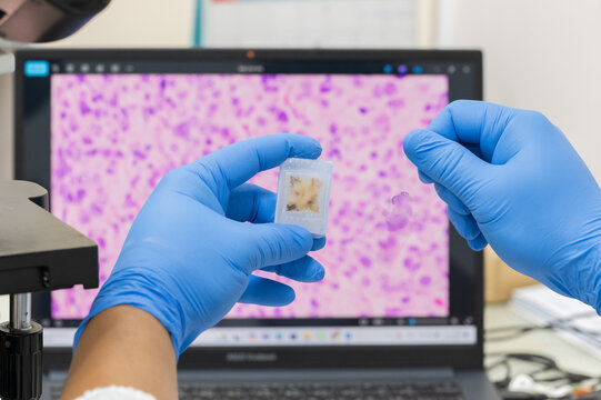 Scientist wear blue glove holding glasses slide and human tissue block and out of focus computer monitor show glandular image from microscope.Medical patholology and cytology laboratory technology