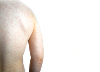 Rash on the child's body on a white background.