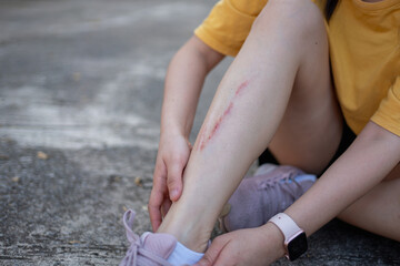 Minor leg injury with scrape after falling on pavement. Concept of accident, safety awareness, first aid, outdoor activity risk, health care, recovery and everyday lifestyle incident.