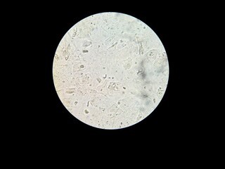 Microscopic view of calcium oxalate crystals and epithelial cells in human urine sediment. Professional laboratory analysis for medical diagnosis, clinical urology, and healthcare research.