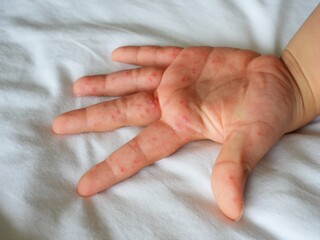 Hand-foot-and-mouth disease (HFMD) rash and blisters on a child's hand and sole.