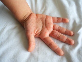 Hand-foot-and-mouth disease (HFMD) rash and blisters on a child's hand and sole.