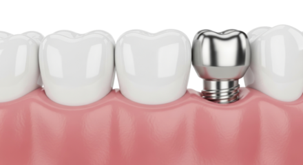Dental implant and crown on tooth transparent background cutout png